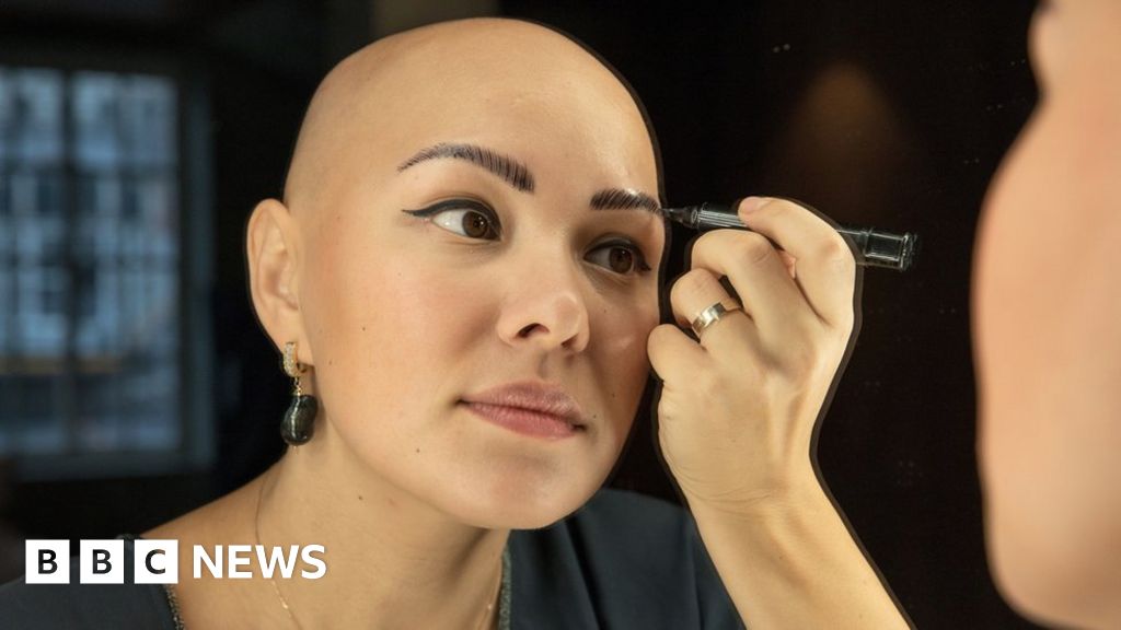 First alopecia treatment recommended on the NHS