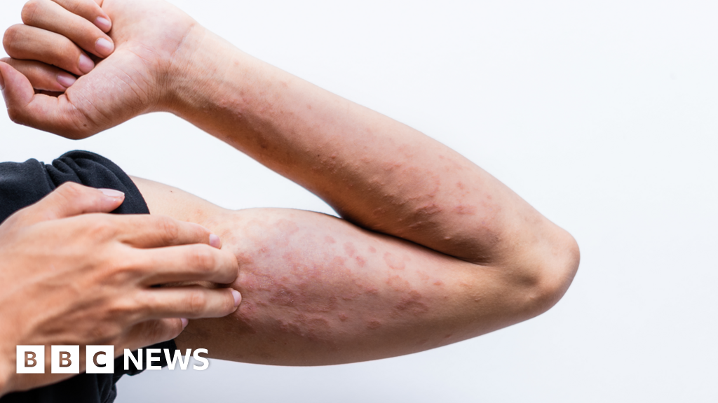 New eczema drug trial recruits Walsall patient, NHS trust says