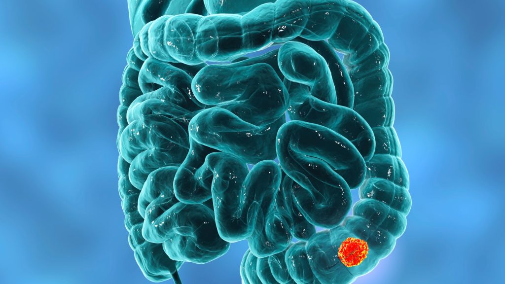 NHS bowel cancer screening will be rolled out to thousands every 2 years in win for Dame Debs’ Sun campaign