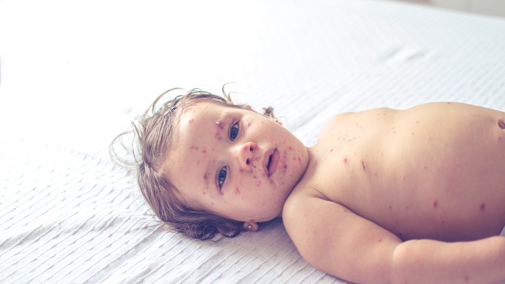 Measles cases rise a ‘concerning’ 34% in a week – with two thirds of infections in children under 10