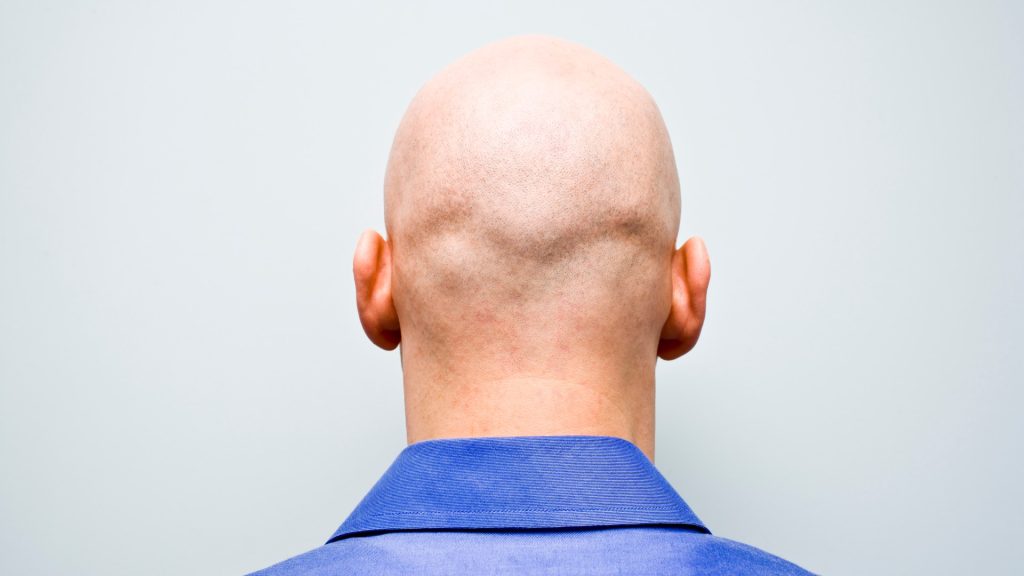 Drug that ‘reverses’ balding could also ‘lower cholesterol and prevent silent killer’