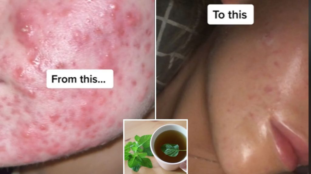 Does spearmint tea really clear acne and give you flawless skin? We asked a skincare expert to find out