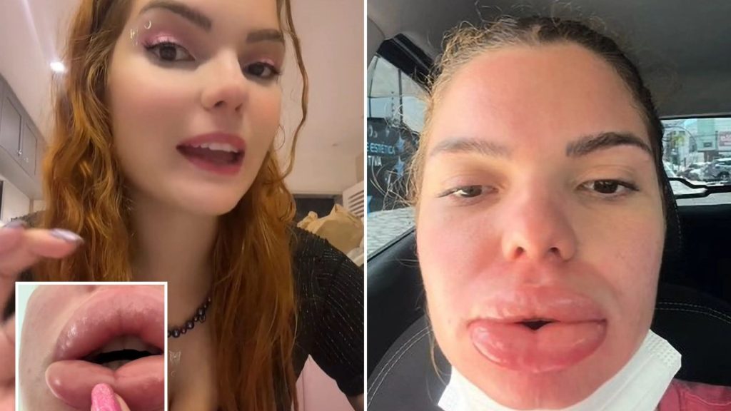 Woman, 27, rushed to hospital in agony after ‘routine’ lip filler cut off blood supply to her mouth
