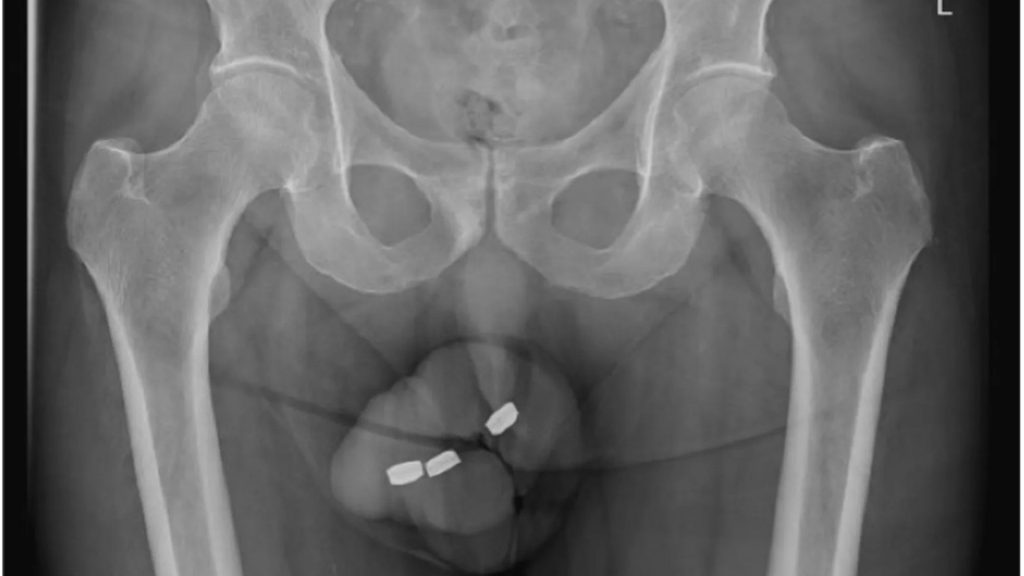 Man’s penis ‘rots from the inside’ after he shoved three button batteries into his urethra