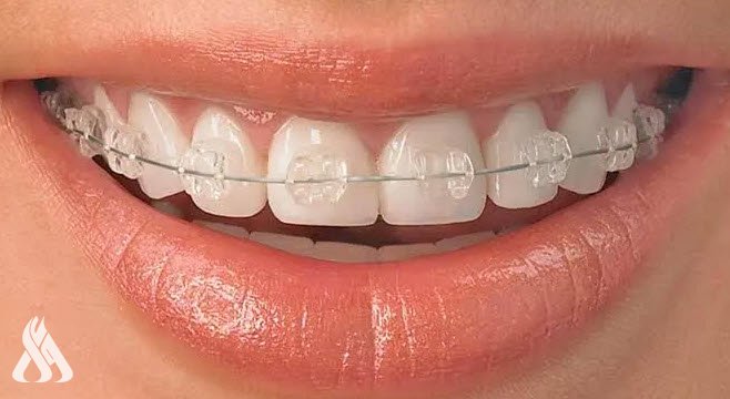 Scientists invent a smart material to make orthodontic devices » Iraqi News Agency