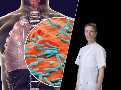 Meer mensen met tuberculose in Nederland: artsen leggen uit hoe deze infectieziekte behandeld wordt