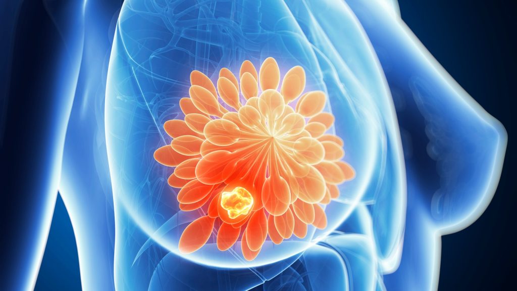 Breast cancer breakthrough as scientists work out how to kill ‘hibernating’ tumour cells