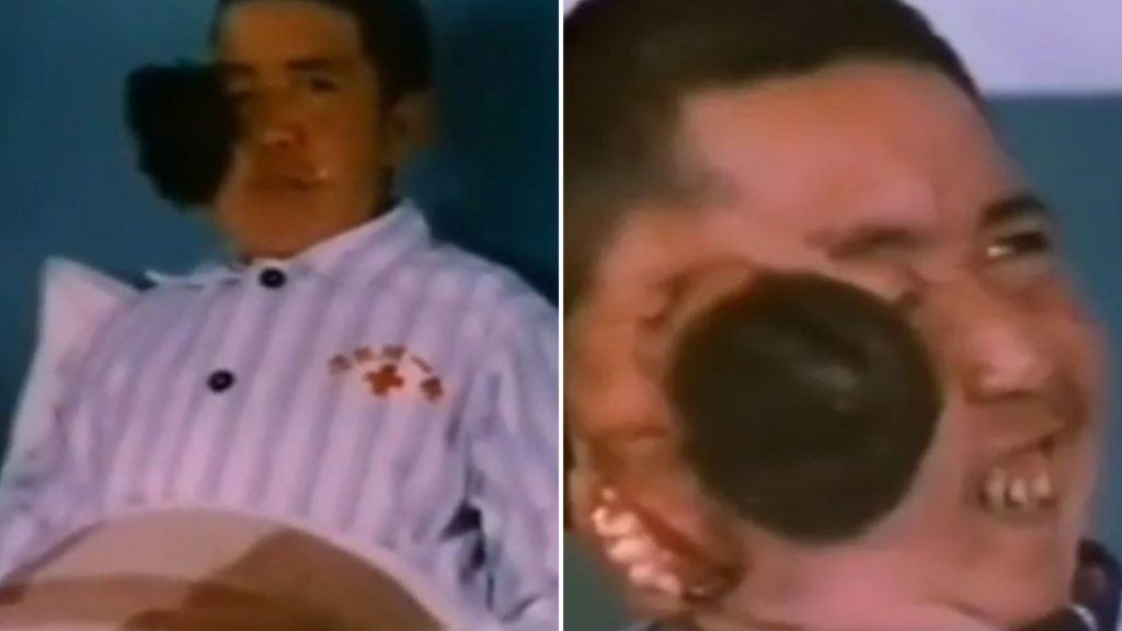 Incredible case of the man with TWO HEADS including a second scalp & teeth-filled mouth on his cheek…which could smile
