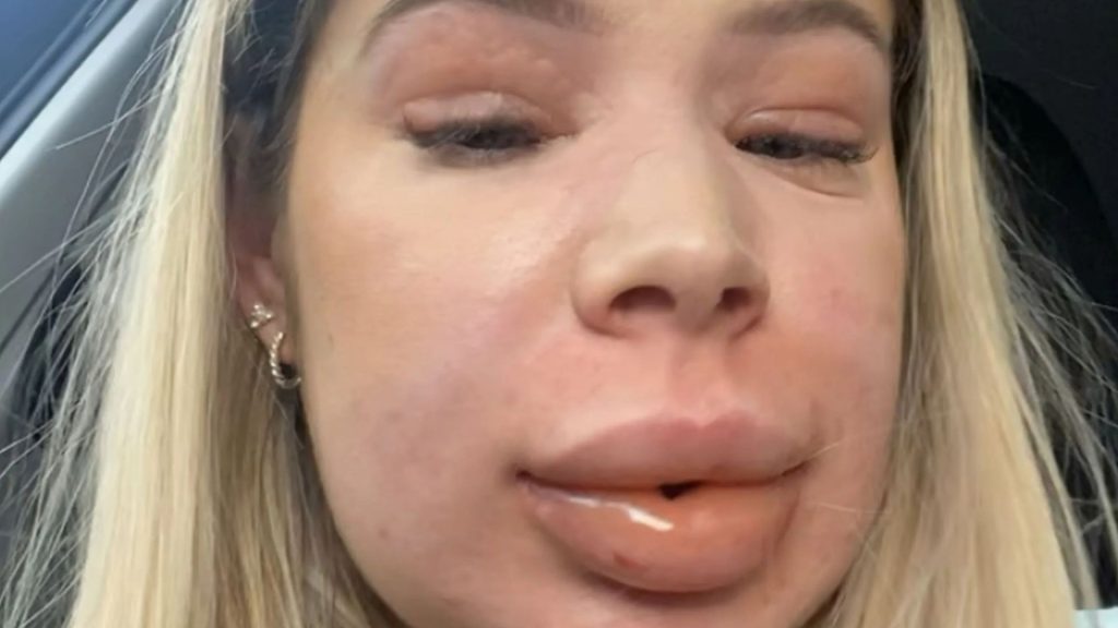 Woman, 24, left ‘gasping for air’ with a ‘balloon face and no eyes’ after getting lip filler dissolved
