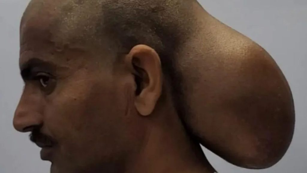 Man with ‘two heads’ for 15 years has tumour size of a melon removed after it ‘damaged his skull’