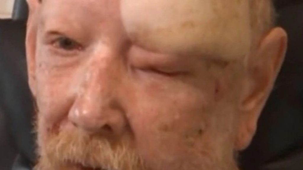 Shock pics reveal terrifying result of NEVER wearing suncream as lifeguard has ‘nearly 200 cancers hacked off his skin’