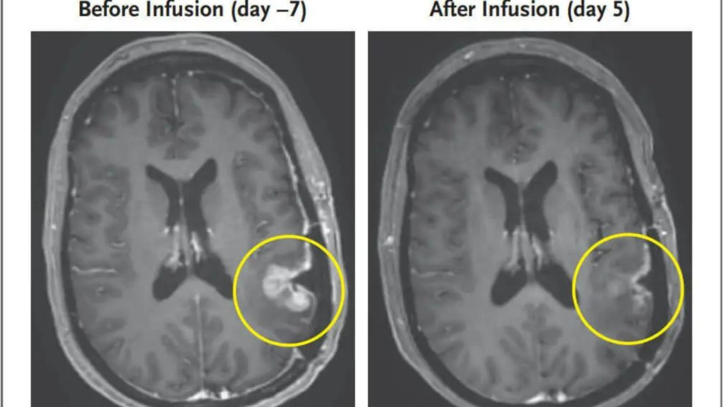 Incredible scans show woman’s brain tumour ‘completely disappear’ in just 5 days after new ‘wonder’ treatment