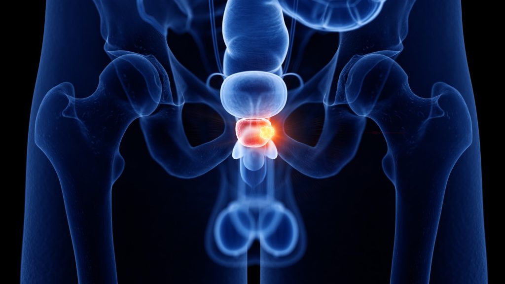 ‘Pivotal’ prostate cancer discovery using AI ‘could save thousands of lives’ and ‘revolutionise how disease is treated’