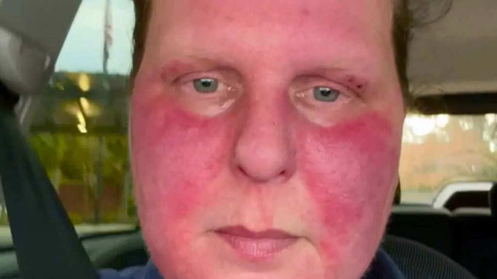 My new ear piercing left my ‘whole body on fire’ – I can’t leave the house and only eat cold food years later