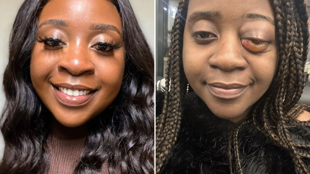 I was dismissed as having conjunctivitis before a cancer diagnosis at 22 – even the optician didn’t spot it