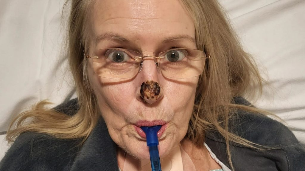 I was hours from death as killer bacteria ate away at my face until BAKING SODA made me ‘rise like a cake’