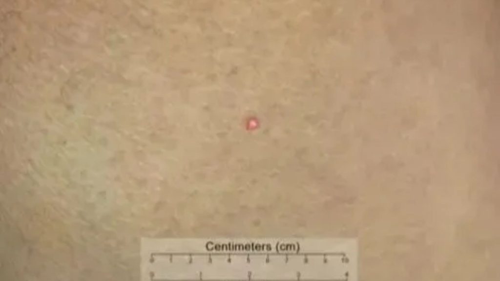Shocking time-lapse video reveals how tiny ‘red mark’ morphs into cancer five times more deadly than melanoma