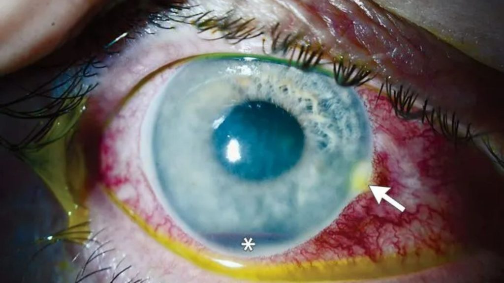 Grim photos reveal how horror bee sting left barbed stinger lodged in man’s eyeball for days
