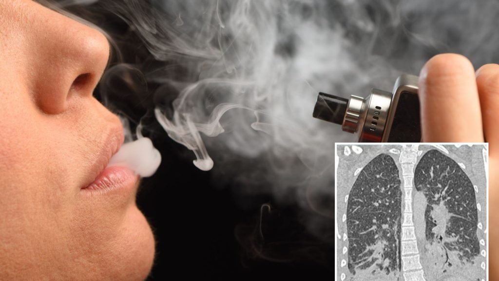 Woman, 19, left fighting for life after vaping leaves her lungs looking like ‘shattered glass’