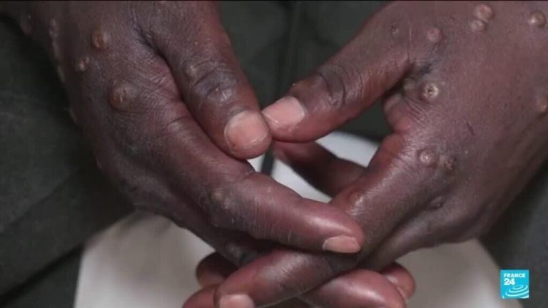 World Health Organization declares mpox a global health emergency