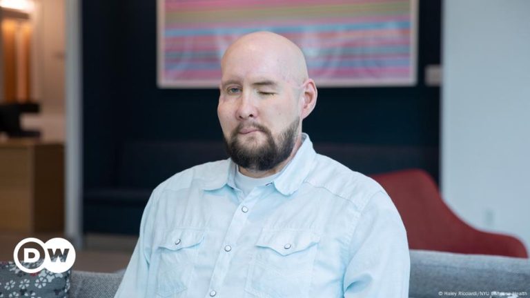 World-first face, eye transplant a ‘cautious’ success story – DW – 09/11/2024