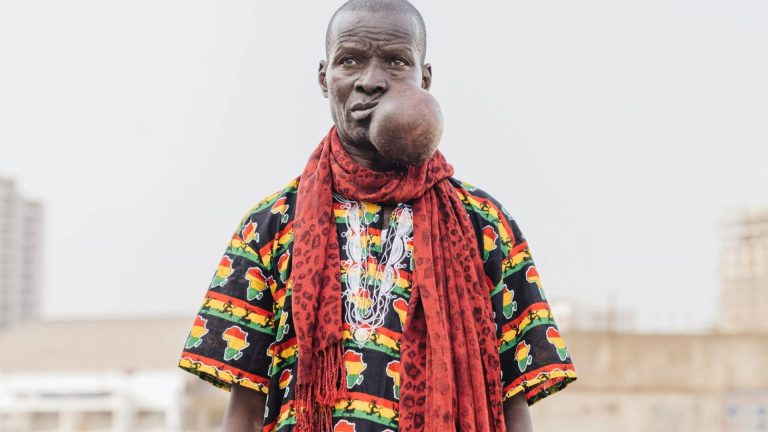 Watch the incredible transformation of man, 64, whose ‘small spot’ blew up into melon-sized tumour