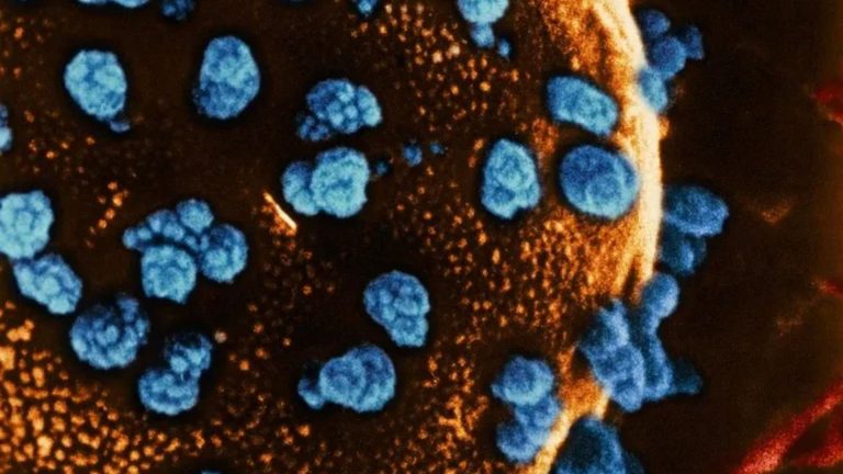 World first as woman, 25, ‘cured’ of her type 1 diabetes after groundbreaking stem cell transplant