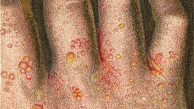 ‘Alarming’ surge in cases of ‘nightmare’ Victorian disease sweeping the UK as GPs urge Brits not to ignore key signs