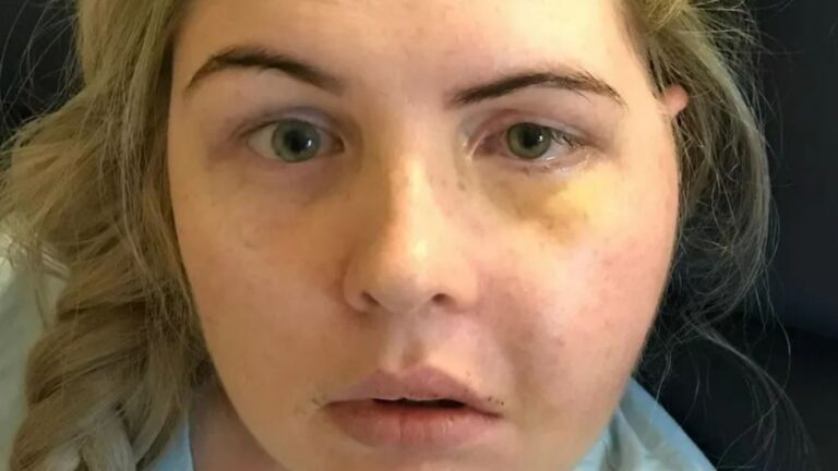 I was a healthy paramedic, 21, but a 60-second headache changed everything – I’m in a wheelchair 9 years later