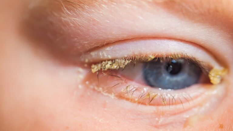 Child with conjunctivitis tests positive for H5N1 bird flu sparking pandemic fears as scientists warn ‘clock is ticking’