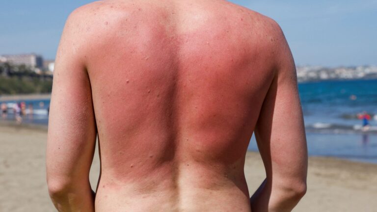 Sunburn isn’t just red skin – here’s what’s happening underneath the burn | Science, Climate & Tech News