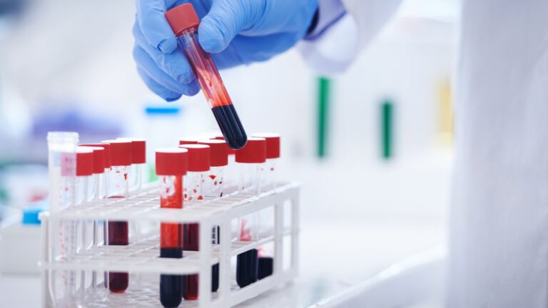 UK patients to trial blood test that could ‘revolutionise’ Alzheimer’s diagnosis | UK News