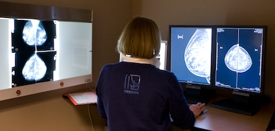 Meer jonge vrouwen krijgen borstkanker: ongezonde leefstijl speelt grotere rol dan hormonen