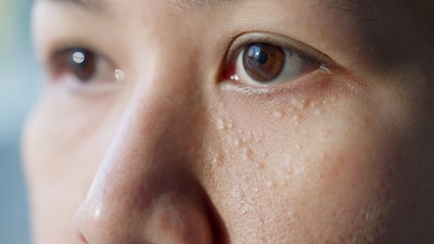 Gerstekorrels niet zo onschuldig als ze lijken: ‘Je mag ze absoluut niet uitknijpen’