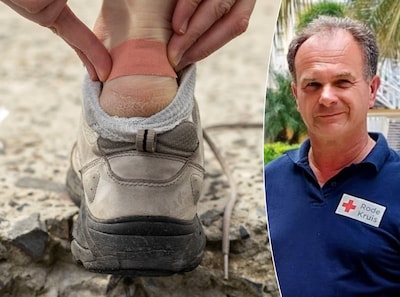 Blaren laat je het beste met rust: EHBO-expert over wanneer doorprikken wél mag